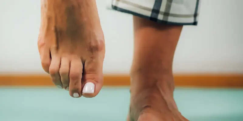 Close-up of bare feet with the base of the big toe in view, the joint affected by hallux rigidus